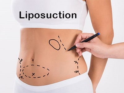 Liposuction Treatment In UK
